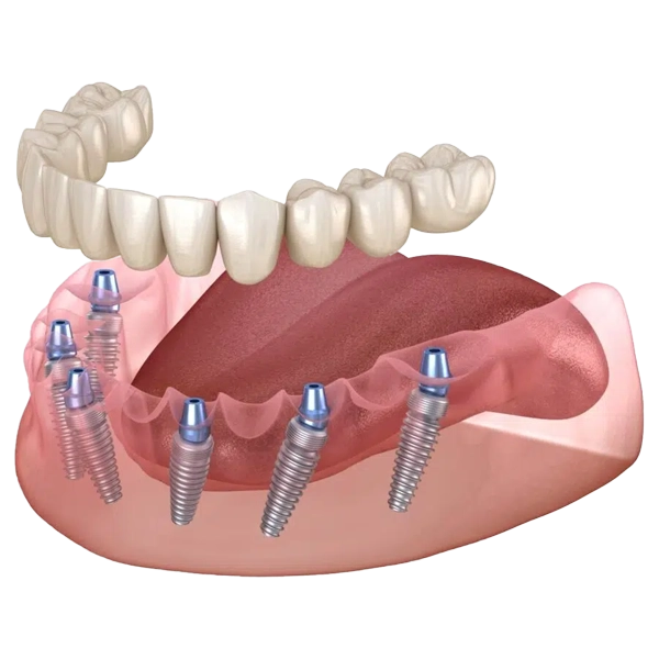 All-on-6 Implants