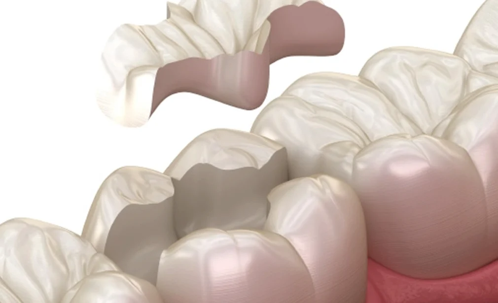 Composite Fiiling