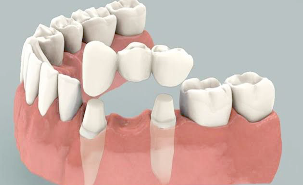 crowns-and-bridge