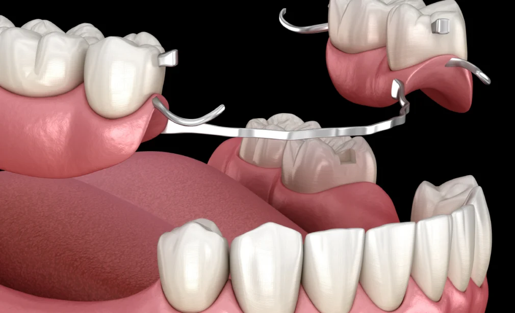 Dental Prosthesis