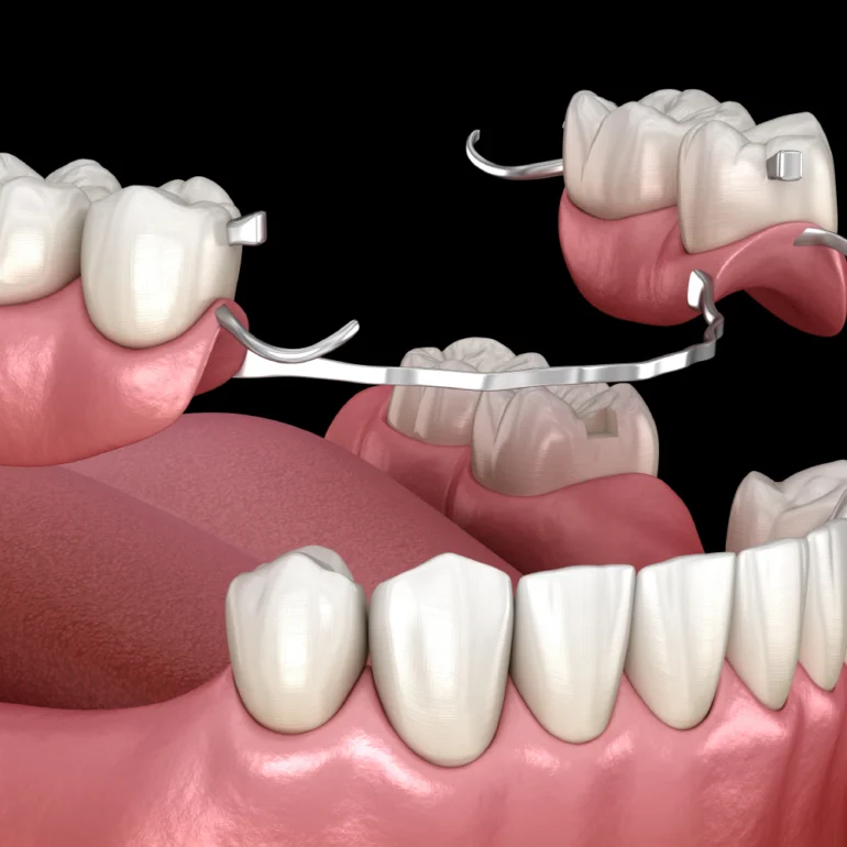 Dental Prosthesis