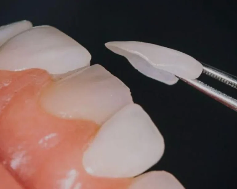 dental-veneers