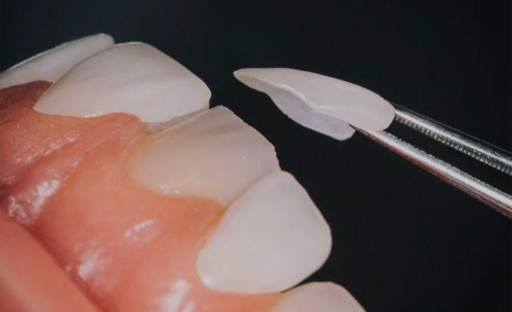 dental-veneers