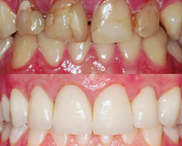 teeth-whitening