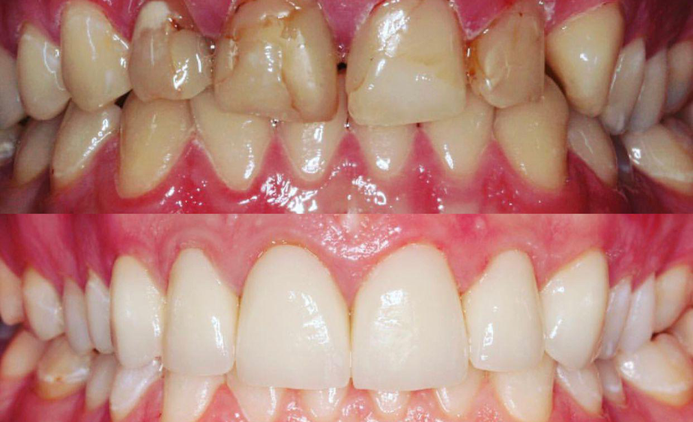 teeth-whitening